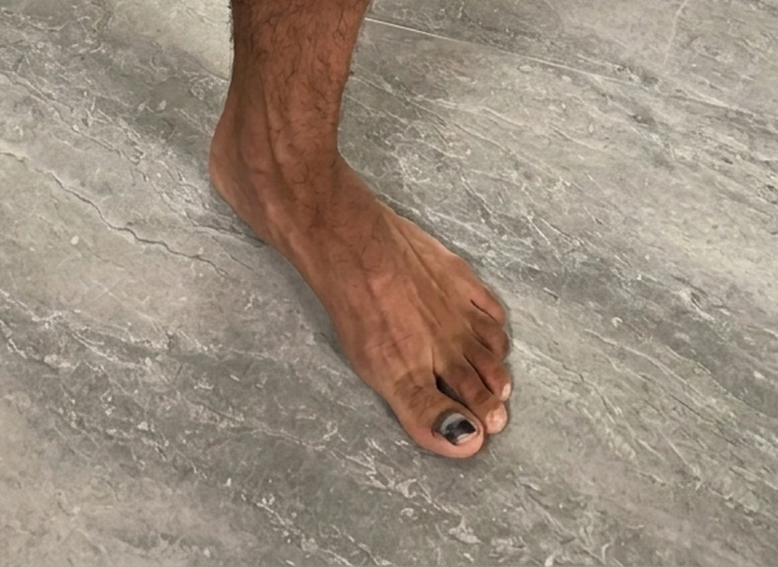 Kuku jempol kaki kanan menghitam, difoto bertelanjang kaki di atas lantai keramik